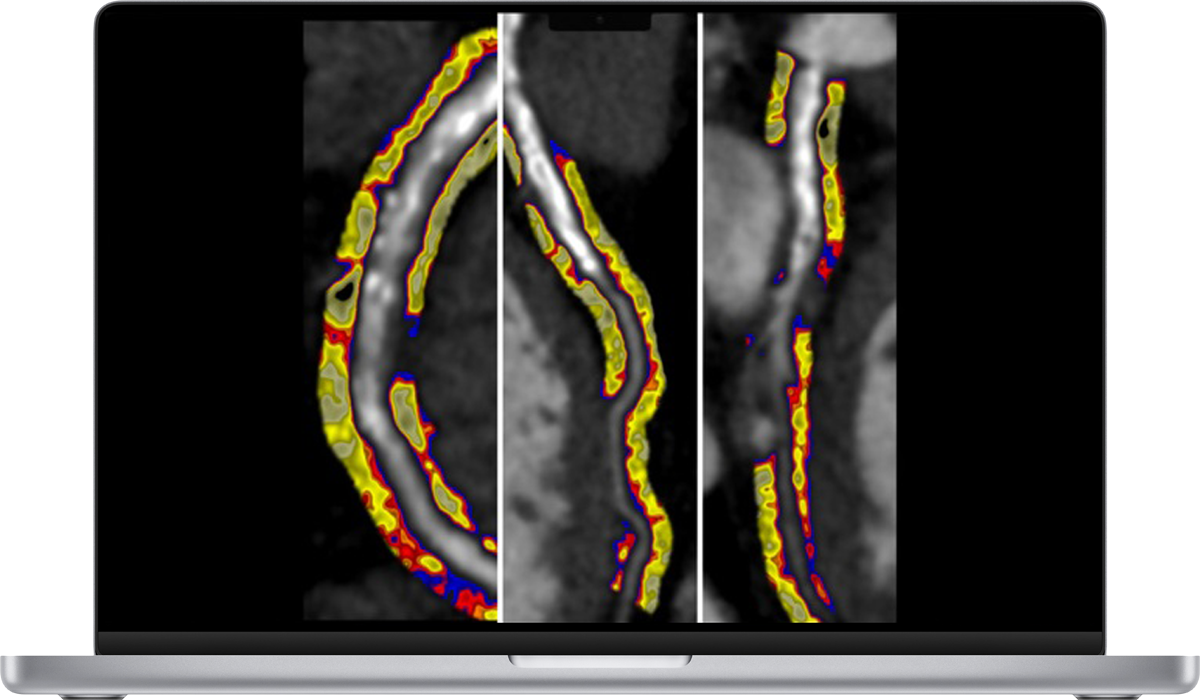 Coronary Inflammation